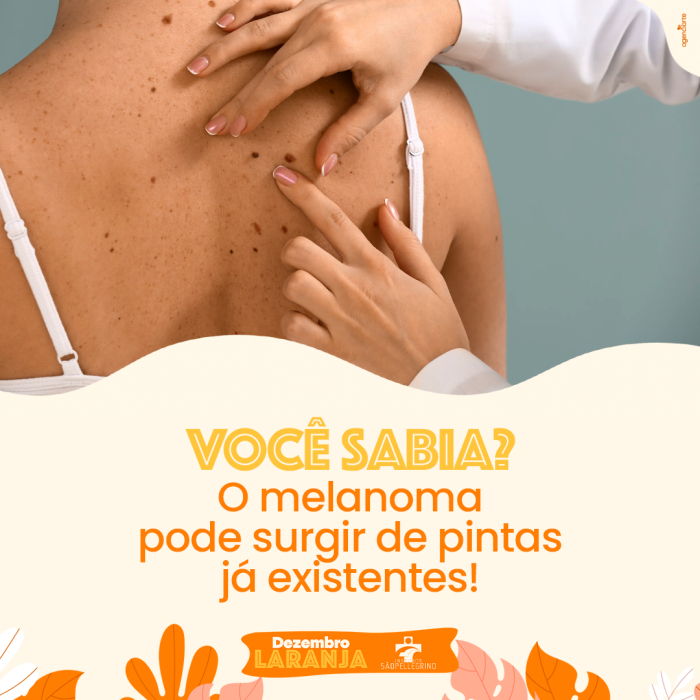 Você Sabia? O Melanoma pode Surgir de Pintas já Existentes!