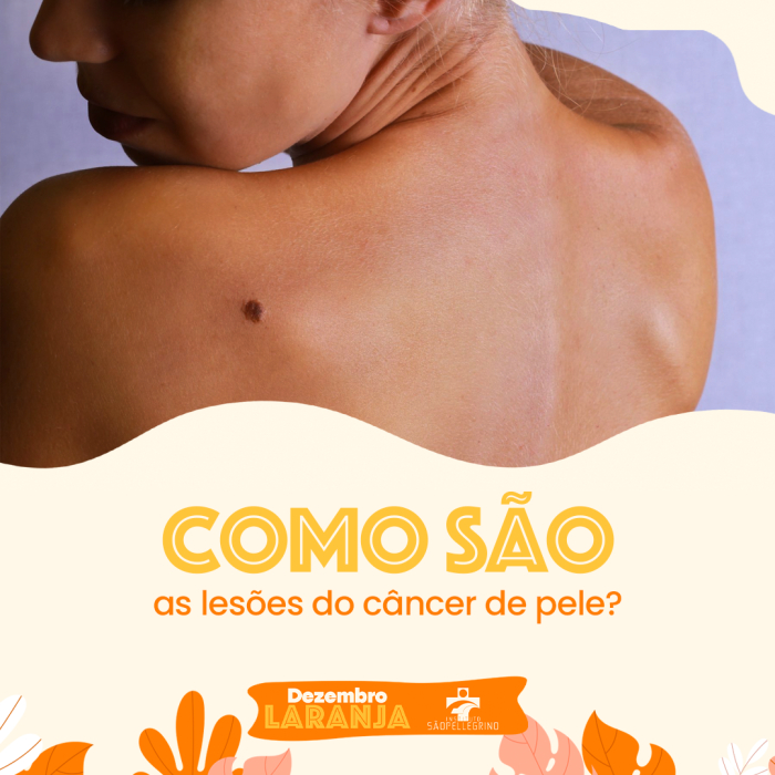 Como são as Lesões do Câncer de Pele.